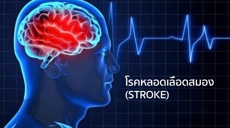 อาการของโรคหลอดเลือดสมอง ( STROKE ) อาการของโรคหลอดเลือดสมอง ( STROKE )