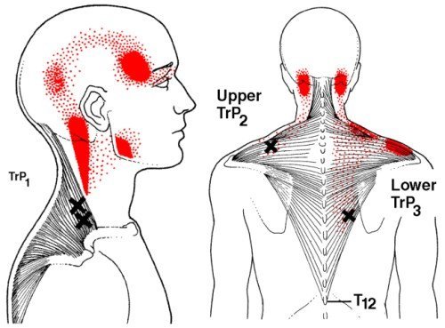 แผนภาพ Trigger Point และอาการปวดร้าว (Referred Pain) ของ Office Syndrome ภาพแสดงตำแหน่งจุดกดเจ็บบนกล้ามเนื้อคอและหลัง และบริเวณที่ปวดร้าวตามมา เช่น ปวดศีรษะ ปวดขมับ ซึ่งเป็นอาการที่พบบ่อยในผู้ที่เป็นออฟฟิศซินโดรม