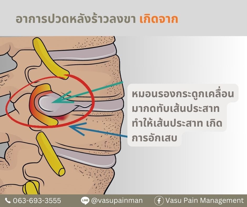 ปวดหลังร้าวลงขา