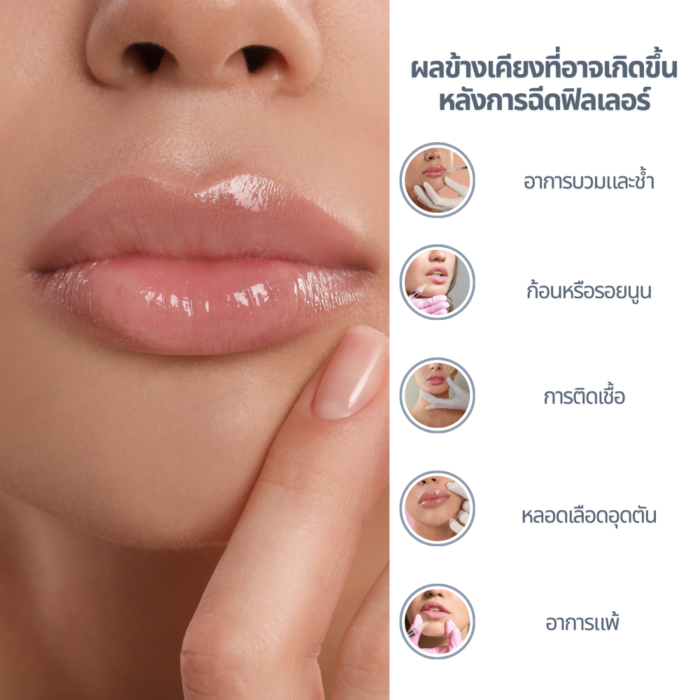 ผลข้างเคียงที่อาจเกิดขึ้นหลังการฉีดฟิลเลอร์ ผลข้างเคียงที่อาจเกิดขึ้นหลังการฉีดฟิลเลอร์