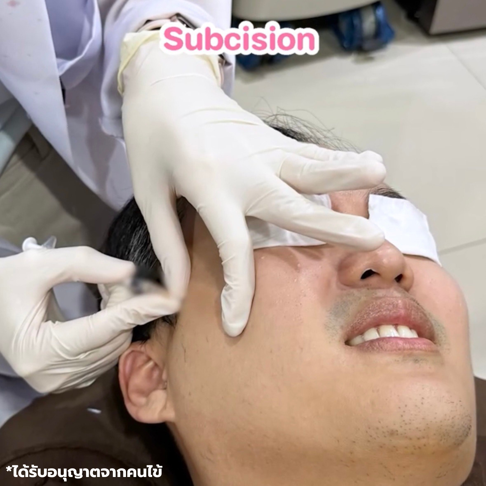 Subcision และ PDRN อะไร? ทำคู่กันดีไหม? ราคาเท่าไหร่? 