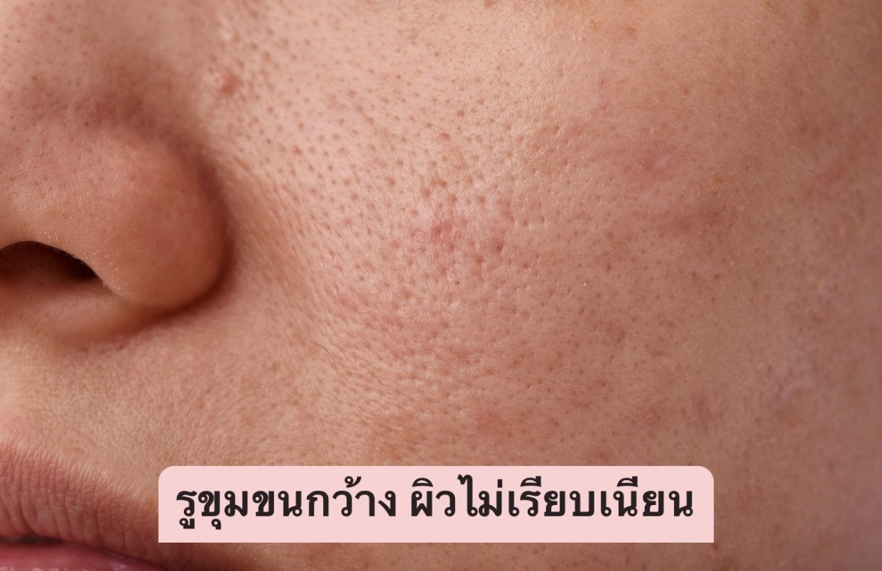 รูขุมขนกว้าง รูขุมขนกว้าง