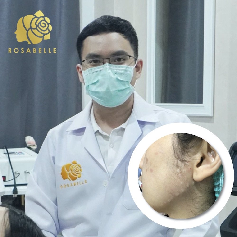 โบท็อกซ์ลิฟท์กรอบโดยแพทย์ ลิฟท์กรอบหน้าเรียวสวย