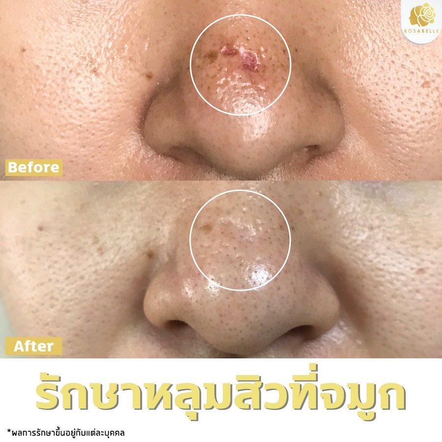 รักษาหลุมสิวที่จมูก รักษาหลุมสิวที่จมูก