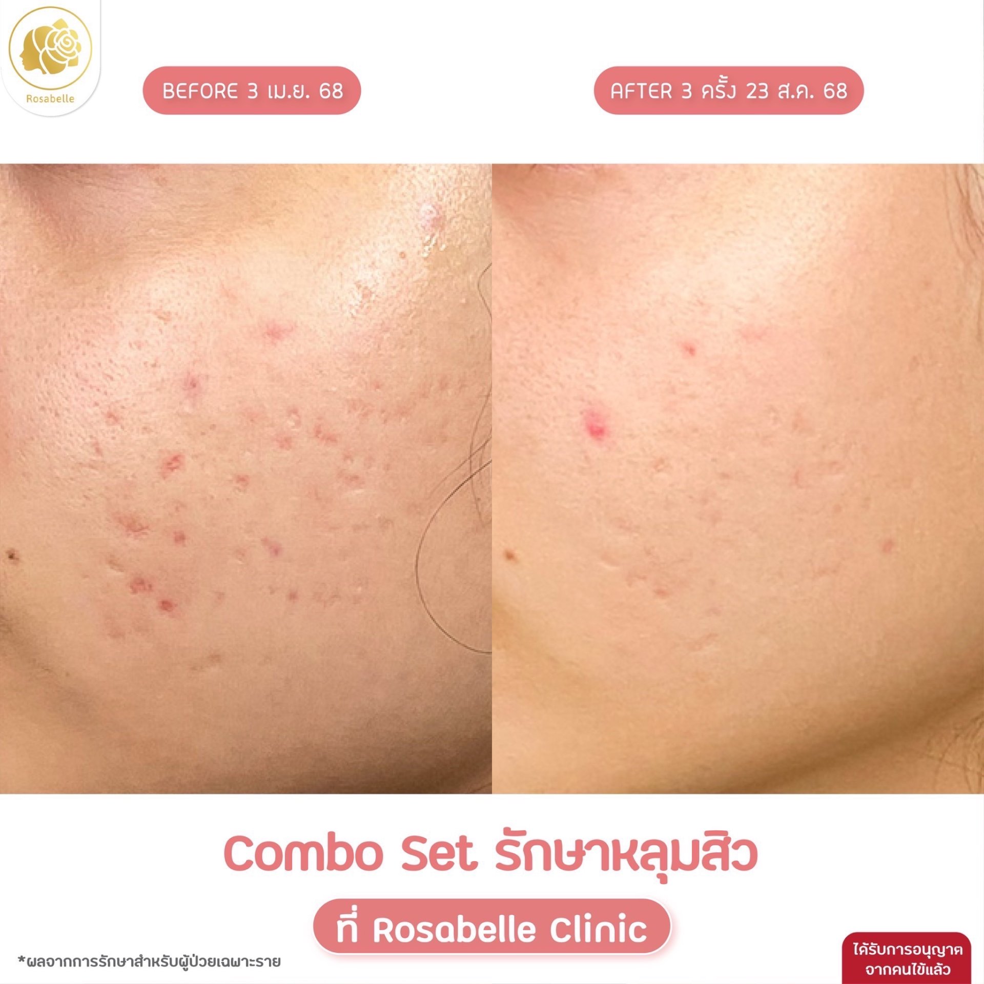 รวมรูปรีวิวโปรแกรมรักษาหลุมสิว