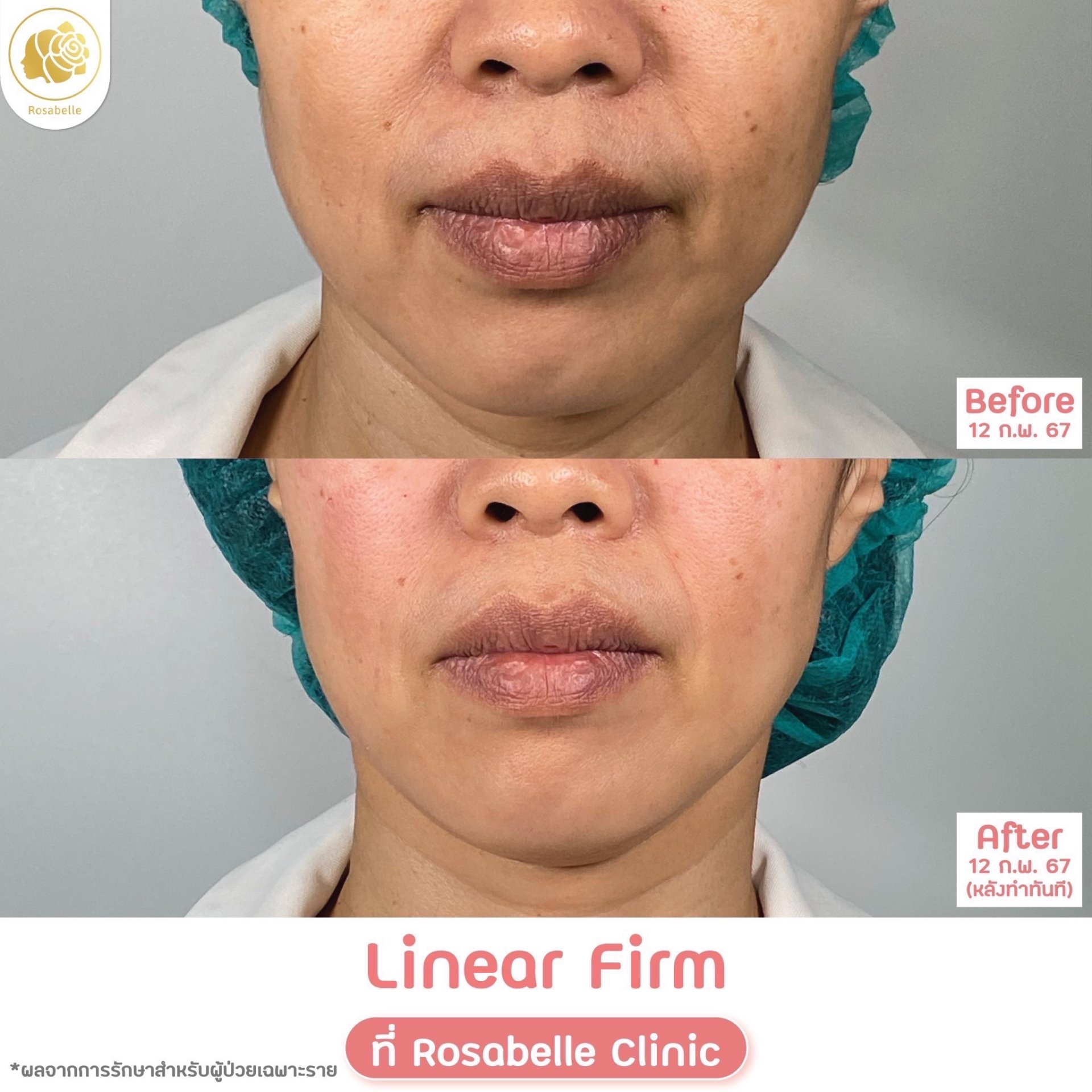 รีวิวโปรแกรม Linear-HIFU