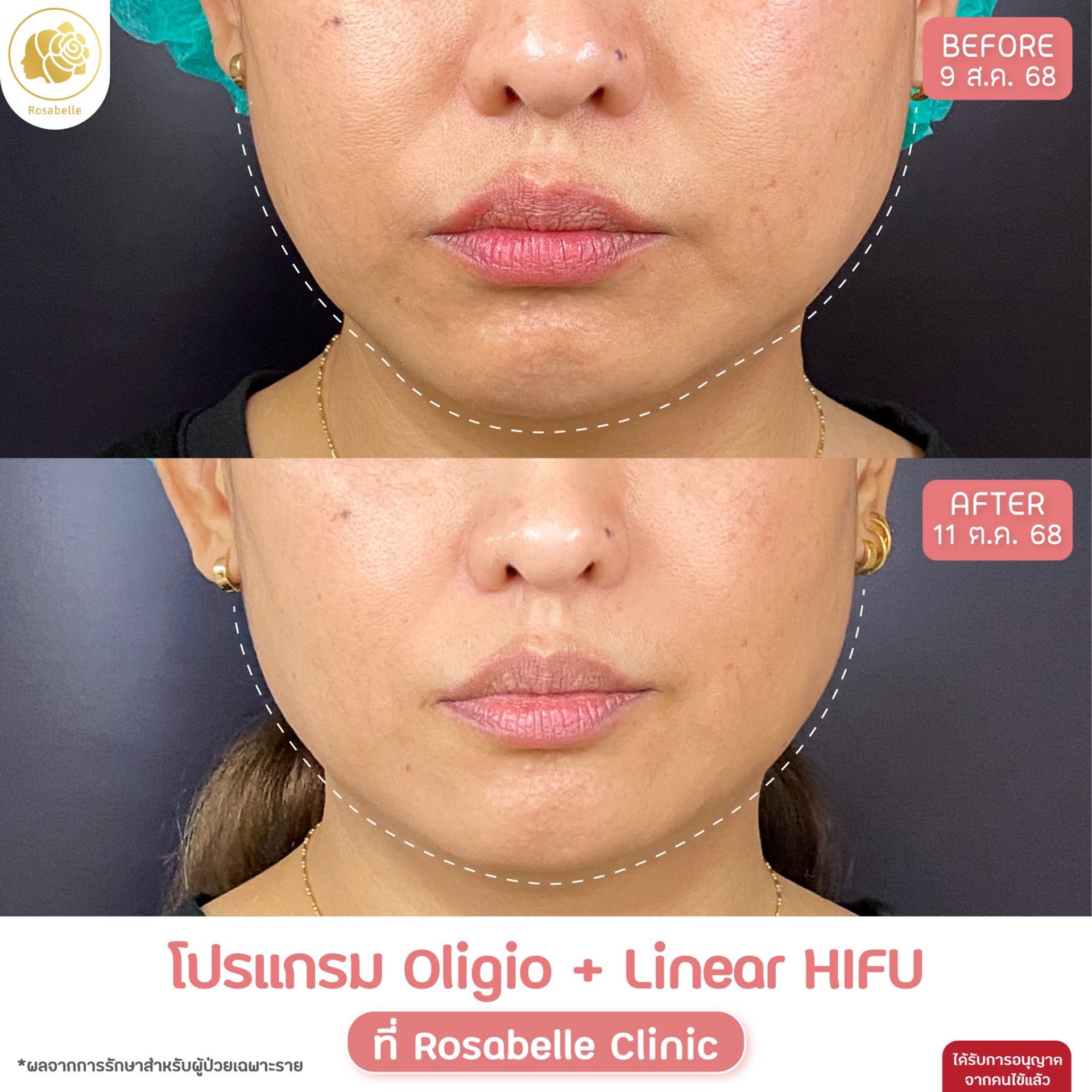 รีวิวโปรแกรม Linear-HIFU & โปรแกรม Oligio  