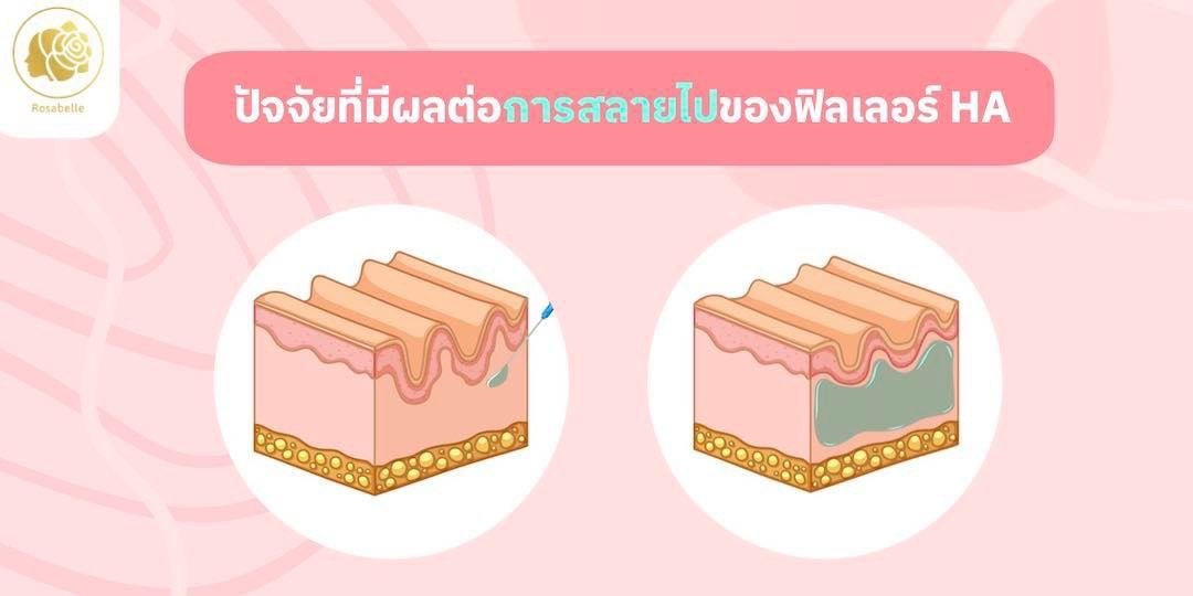 ปัจจัยอะไรบ้างที่ทำให้ฟิลเลอร์สลายไปได้เร็ว? ปัจจัยอะไรบ้างที่ทำให้ฟิลเลอร์สลายไปได้เร็ว?