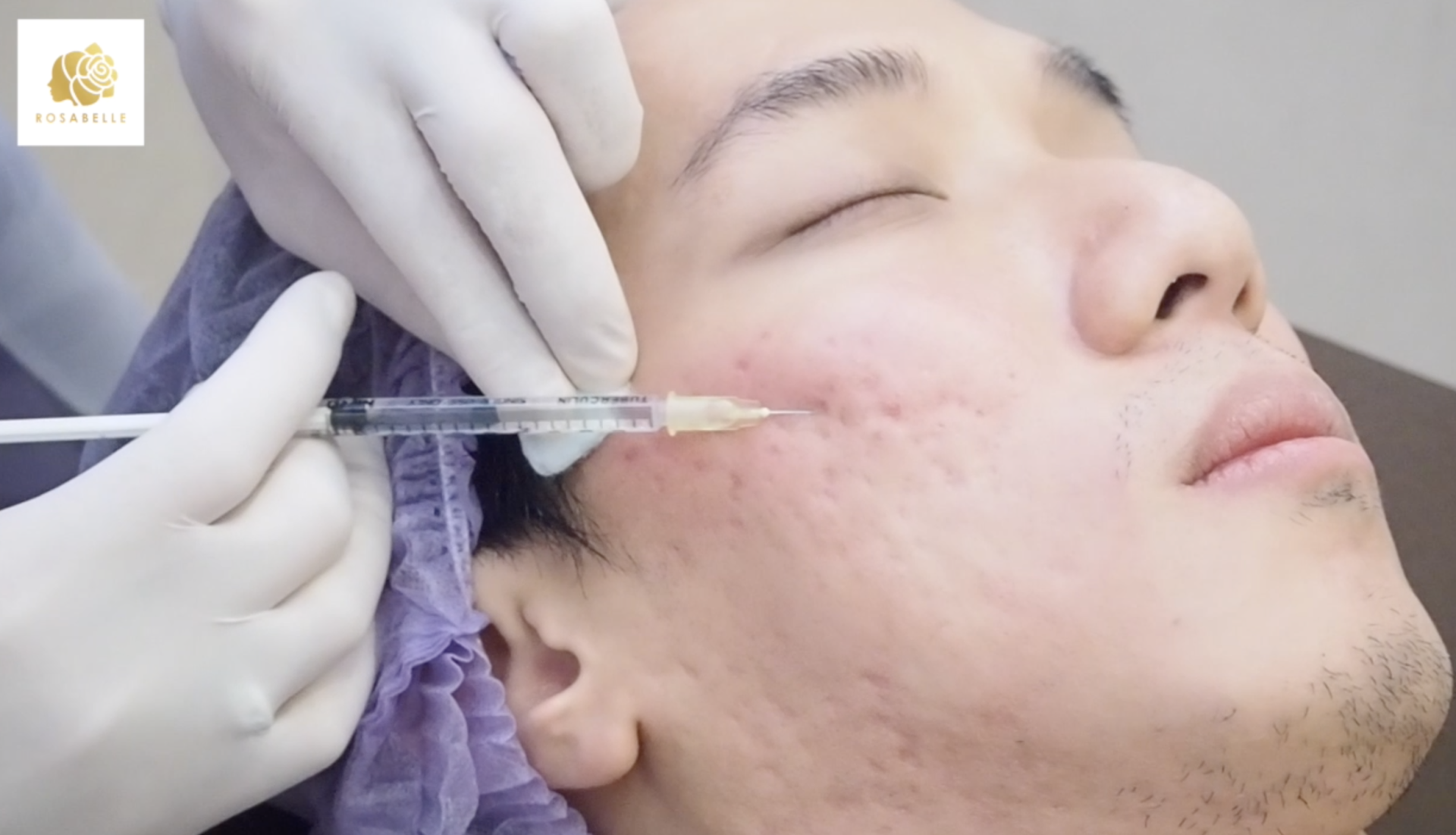 Subcision เทคนิคการรักษาหลุมสิว เห็นผลดีเยี่ยม Subcision เทคนิคการรักษาหลุมสิว เห็นผลดีเยี่ยม