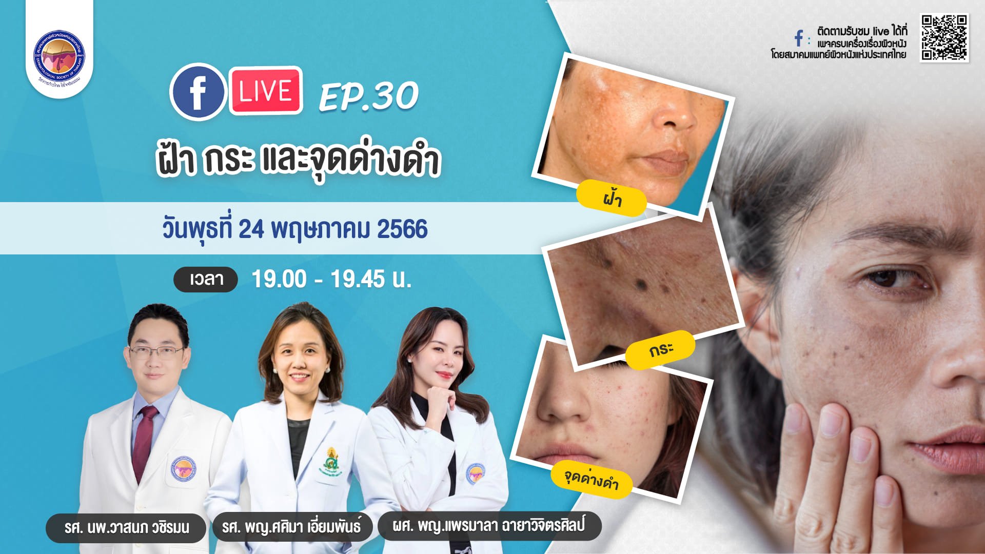 เชิญชม Facebook Live “ครบเครื่องเรื่องผิวหนัง” EP.30 ตอน "ฝ้า กระและจุดด่างดำ”