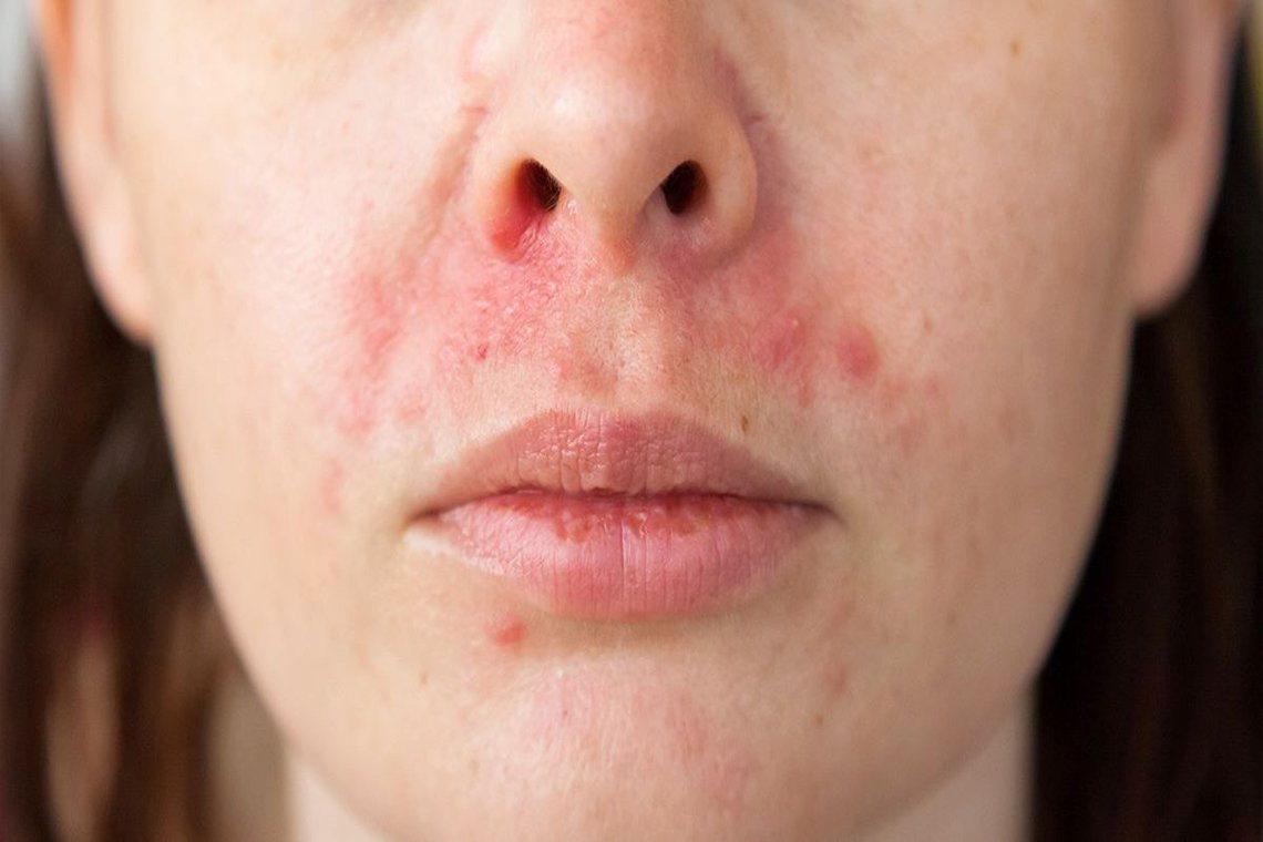 ผื่นแดง เป็นขุย แสบคัน ระวังอาจเป็น "โรคเซ็บเดิร์ม" ภาวะเรื้อรังที่ทำเสียเซลฟ์ ผื่นแดง เป็นขุย แสบคัน ระวังอาจเป็น "โรคเซ็บเดิร์ม" ภาวะเรื้อรังที่ทำเสียเซลฟ์