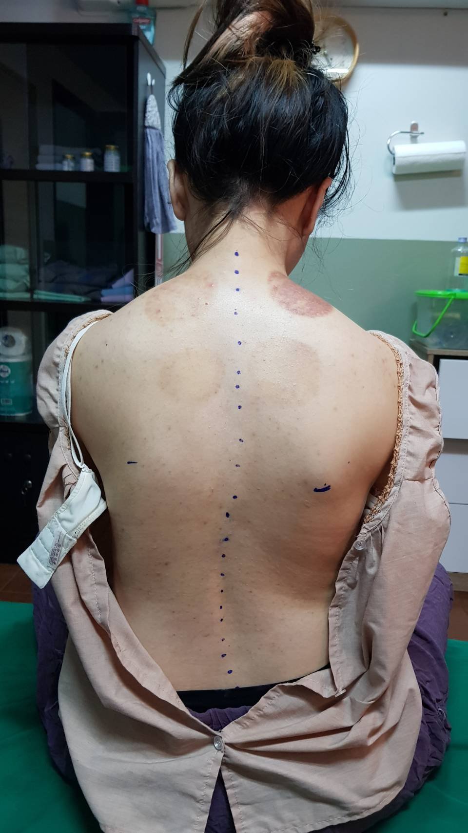ตัวอย่างการรักษากระดูกสันหลังคด ไหล่สูงต่ำไม่เท่ากัน คอเอียง เอวเบี้ยว ตัวอย่างการรักษากระดูกสันหลังคด ไหล่สูงต่ำไม่เท่ากัน คอเอียง เอวเบี้ยว