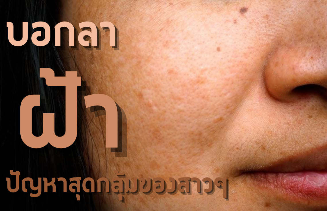 บอกลา "ฝ้า" ปัญหาสุดกลุ้มของสาวๆ บอกลา "ฝ้า" ปัญหาสุดกลุ้มของสาวๆ