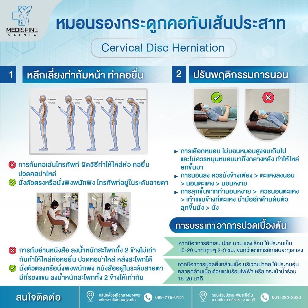 หมอนรองกระดูกคอทับเส้นประสาท หมอนรองกระดูกคอทับเส้นประสาท