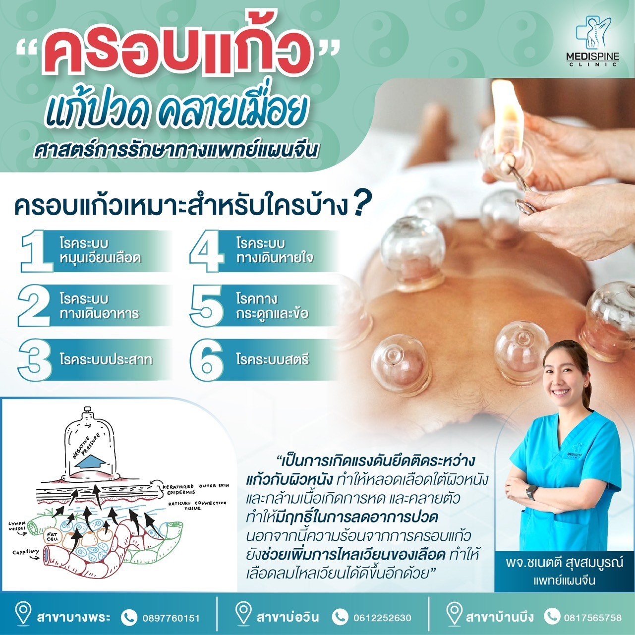 ครอบแก้ว แก้ปวด คลายเมื่อย ศาสตร์การรักษาทางแพทย์แผนจีน ครอบแก้ว แก้ปวด คลายเมื่อย ศาสตร์การรักษาทางแพทย์แผนจีน