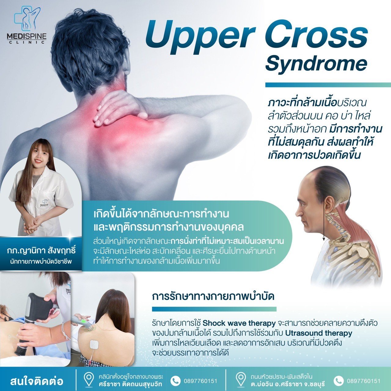 Upper Cross Syndrome ภาวะกล้ามเนื้อคอ บ่า ไหล่ ทำงานไม่สมดุล