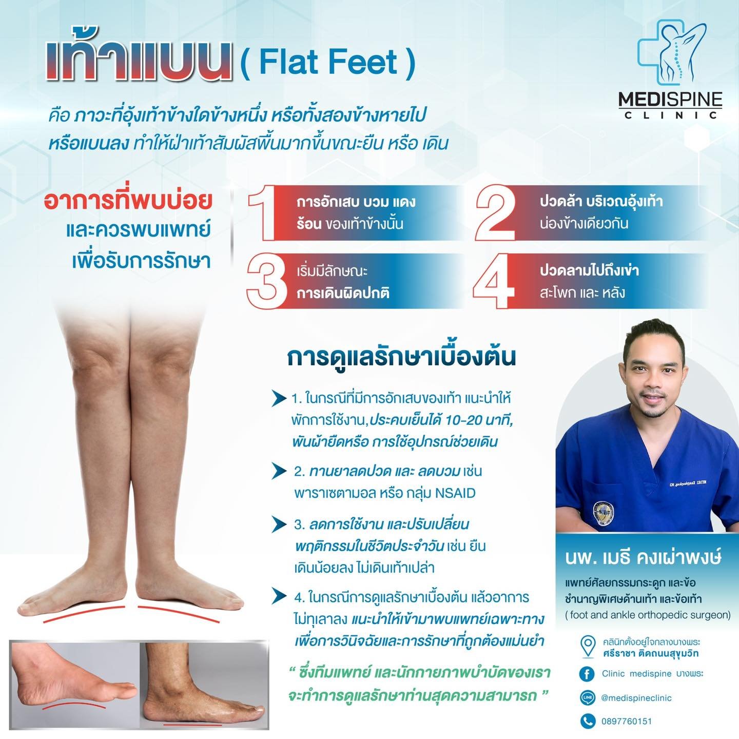 ภาวะเท้าแบนเกิดจากอะไร? เราจะสังเกตและดูแลอย่างไร? ภาวะเท้าแบนเกิดจากอะไร? เราจะสังเกตและดูแลอย่างไร?