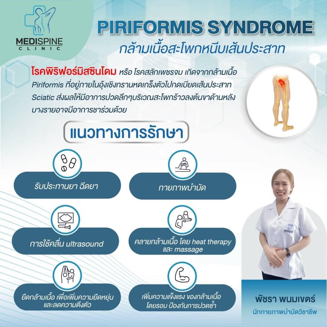 โรคกล้ามเนื้อสะโพกหนีบเส้นประสาท หรือ Piriformis syndrome 