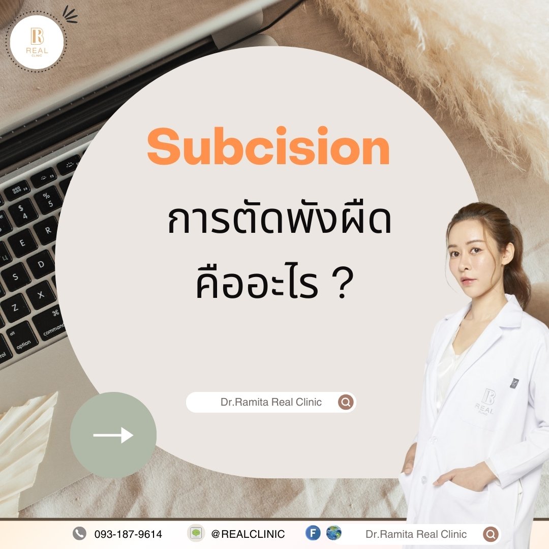 Subcision หลุมสิว (การตัดพังผืด รักษาหลุมสิว) เพียงพอแล้วหรือไม่ ถ้าต้องการผลลัพธ์ที่ดียิ่งกว่า มีวิธีไหนอีกบ้าง?