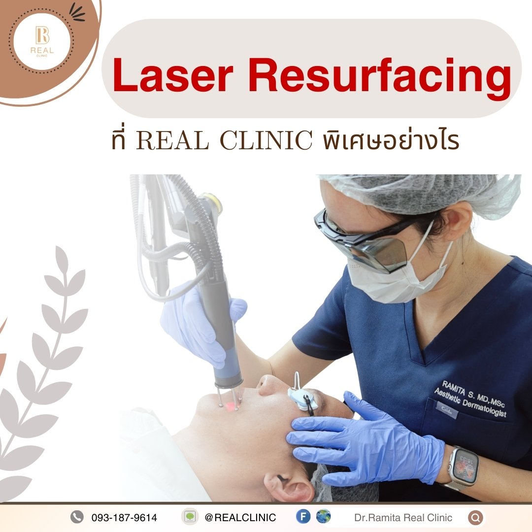 การทำ Laser resurfacing เลเซอร์เกลี่ยขอบหลุมสิว (เลเซอร์หลุมสิว) ที่ Real Clinic