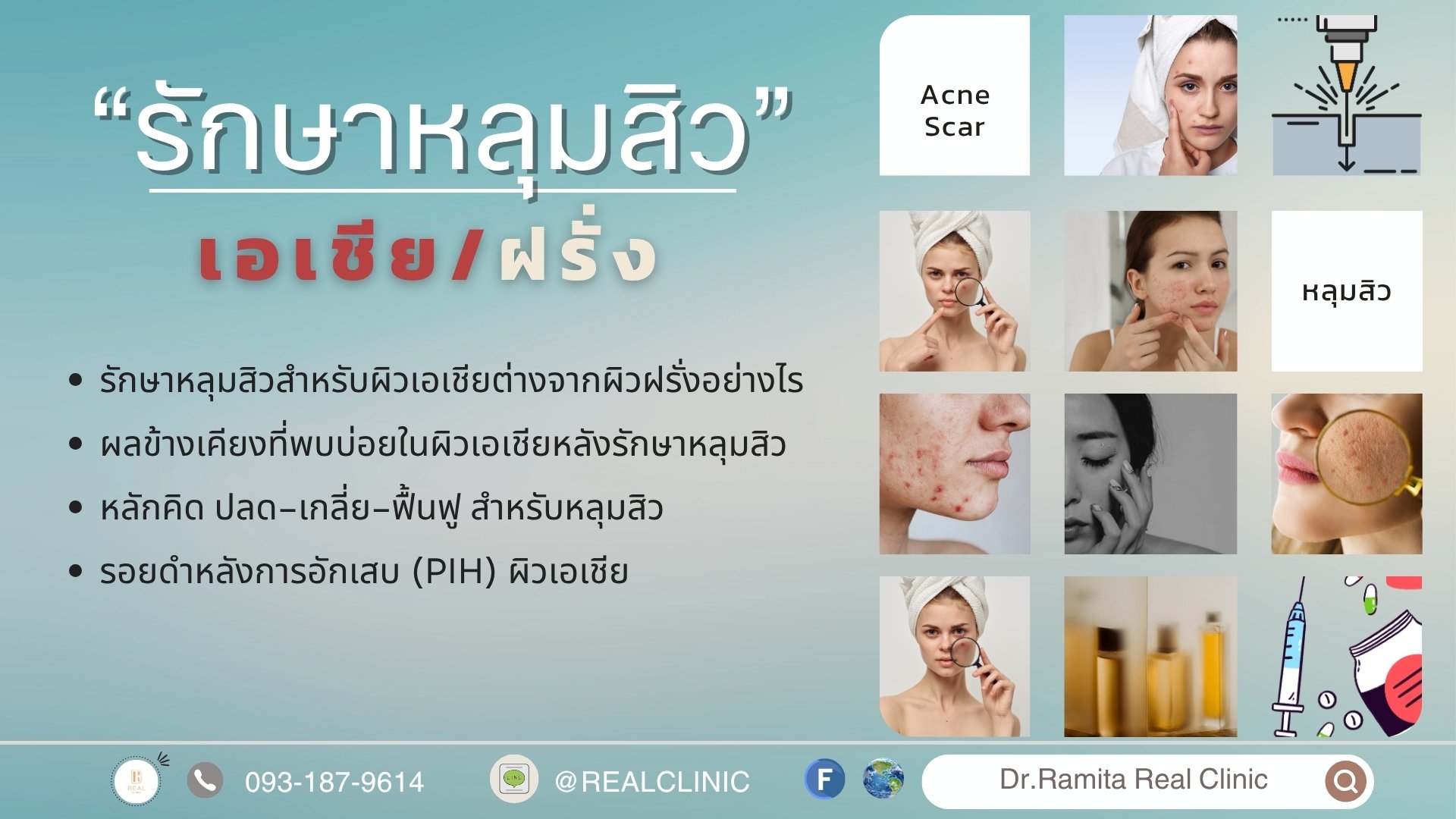 รักษาหลุมสิวฉบับผิวเอเชีย: ทำไมต้องรักษาคนละวิธีกับฝรั่ง? 