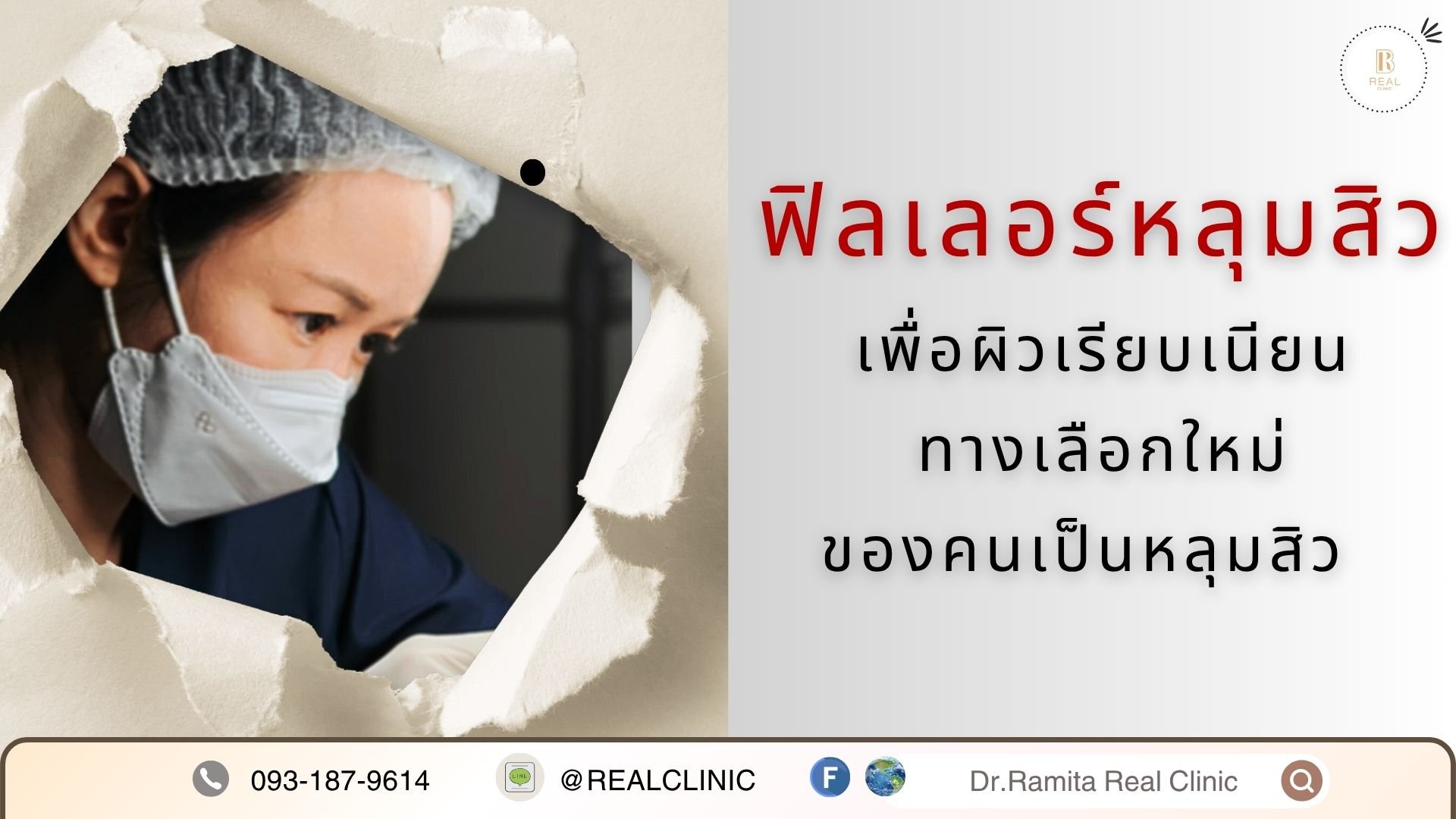 ฟิลเลอร์หลุมสิว
