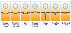 หลุมสิวเกิดจากอะไร? หลุมสิวมีกี่แบบ  หลุมสิวเกิดจากอะไร? หลุมสิวมีกี่แบบ