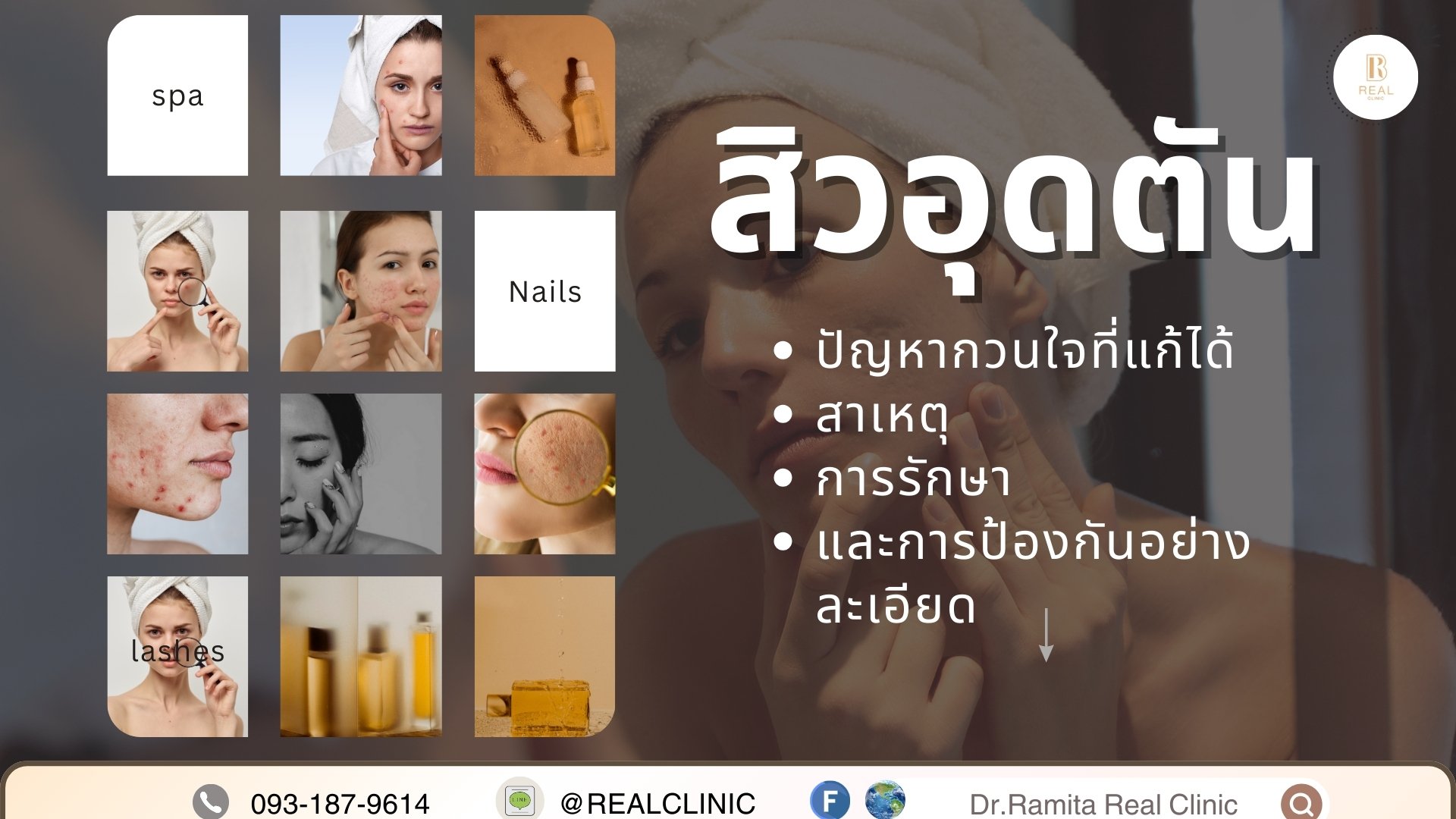 สิวอุดตัน juvgen ดร.จิน หลุมสิวเกาหลี real scar synergy รักษาหลุมสิว