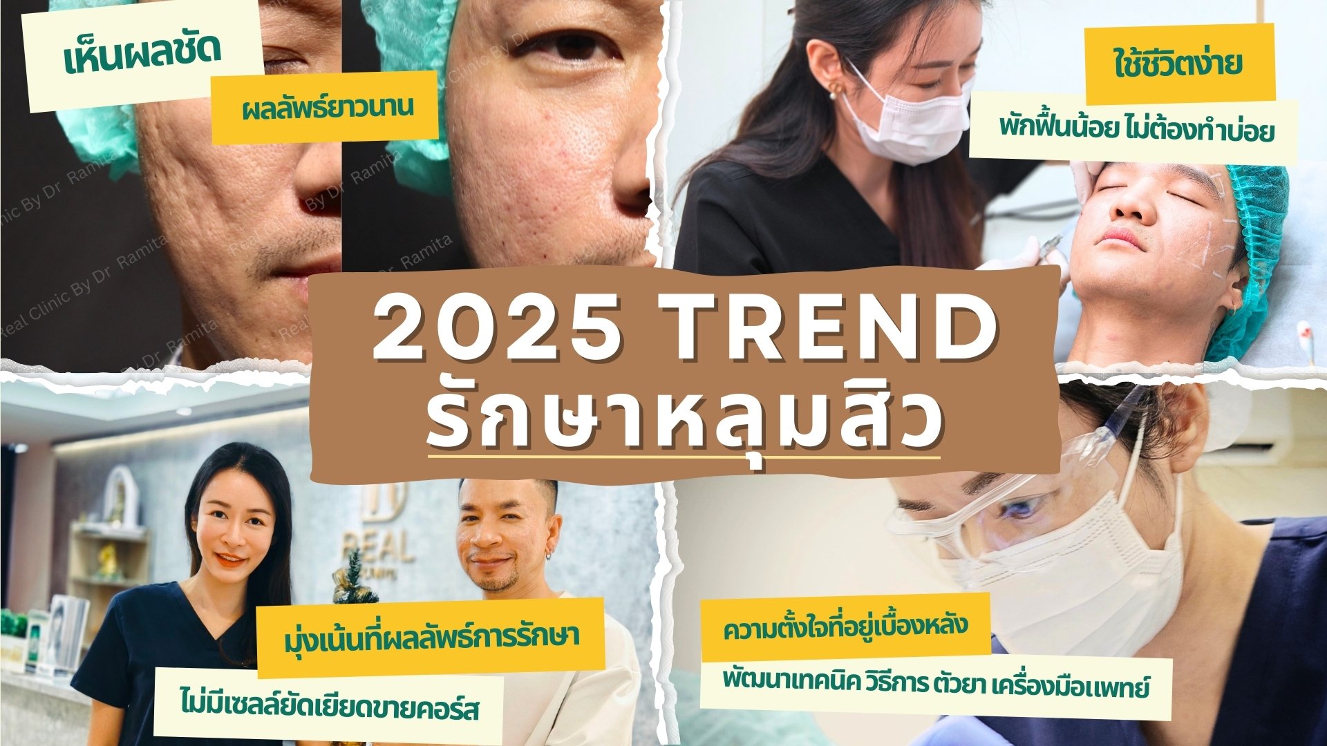 อัปเดตเทรนด์ การรักษาหลุมสิวปี 2025/2568 เห็นผลชัด พักฟื้นน้อย ไม่ต้องทำบ่อย ใช้ชีวิตง่าย ผลลัพธ์ยาวนาน