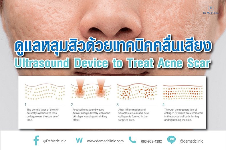 ดูแลหลุมสิวด้วยเทคนิคคลื่นเสียง Ultrasound Device to Treat Acne Scar ดูแลหลุมสิวด้วยเทคนิคคลื่นเสียง Ultrasound Device to Treat Acne Scar