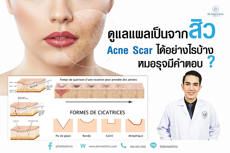 ดูแลแผลเป็นจากสิว Acne Scar ได้อย่างไรบ้าง หมอรุจมีคำตอบ ? ดูแลแผลเป็นจากสิว Acne Scar ได้อย่างไรบ้าง หมอรุจมีคำตอบ ?