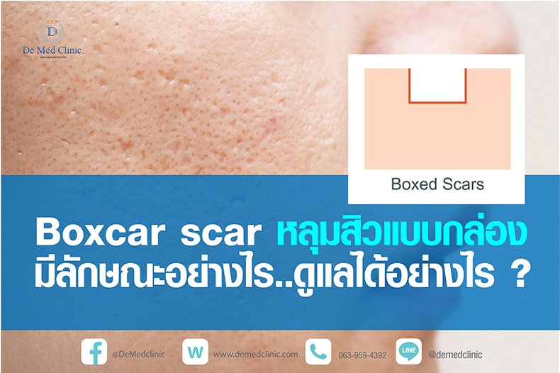 Boxcar scar หลุมสิวแบบกล่อง มีลักษณะอย่างไร ดูแลได้อย่างไร ? Boxcar scar หลุมสิวแบบกล่อง มีลักษณะอย่างไร ดูแลได้อย่างไร ?