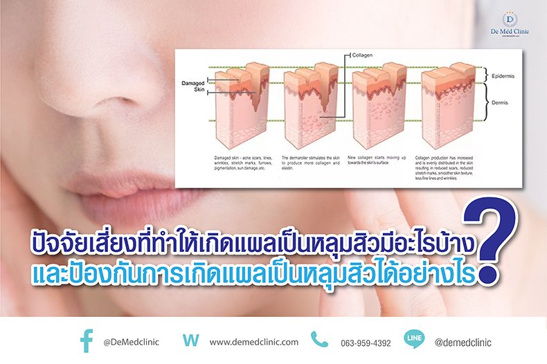 ปัจจัยเสี่ยงที่ทำให้เกิดแผลเป็นหลุมสิวมีอะไรบ้าง ? และปัองกันการเกิดแผลเป็นหลุมสิวได้อย่างไร ? ปัจจัยเสี่ยงที่ทำให้เกิดแผลเป็นหลุมสิวมีอะไรบ้าง ? และปัองกันการเกิดแผลเป็นหลุมสิวได้อย่างไร ?