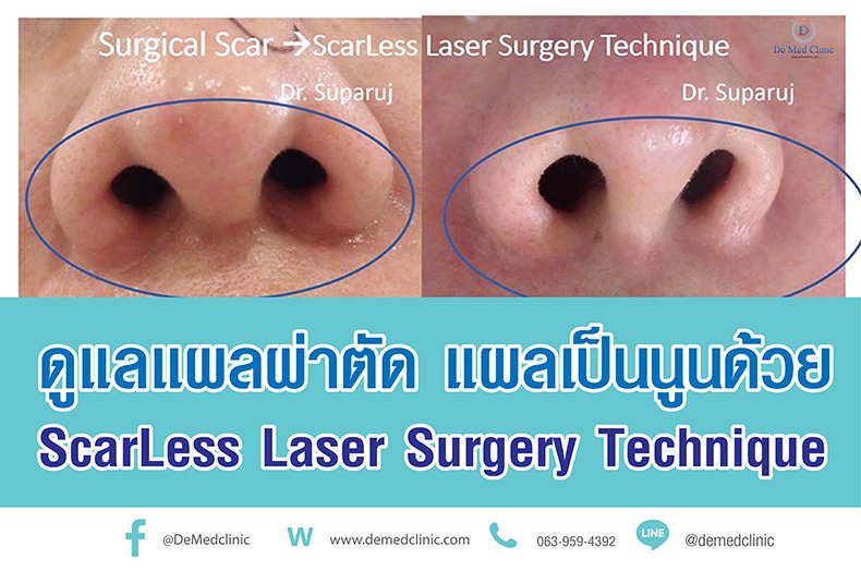 ดูแลแผลผ่าตัด แผลเป็นนูนด้วย ScarLess Laser Surgery Technique ดูแลแผลผ่าตัด แผลเป็นนูนด้วย ScarLess Laser Surgery Technique
