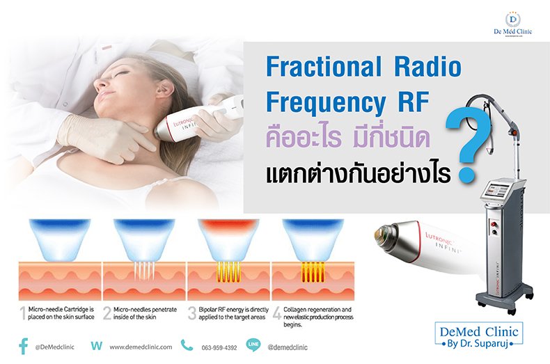 Fractional Radio Frequency RF คืออะไร มีกี่ชนิด แตกต่างกันอย่างไร ? Fractional Radio Frequency RF คืออะไร มีกี่ชนิด แตกต่างกันอย่างไร ?