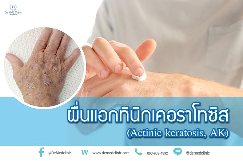ผื่นแอกทินิกเคอราโทซิส (Actinic keratosis, AK) ผื่นแอกทินิกเคอราโทซิส (Actinic keratosis, AK)
