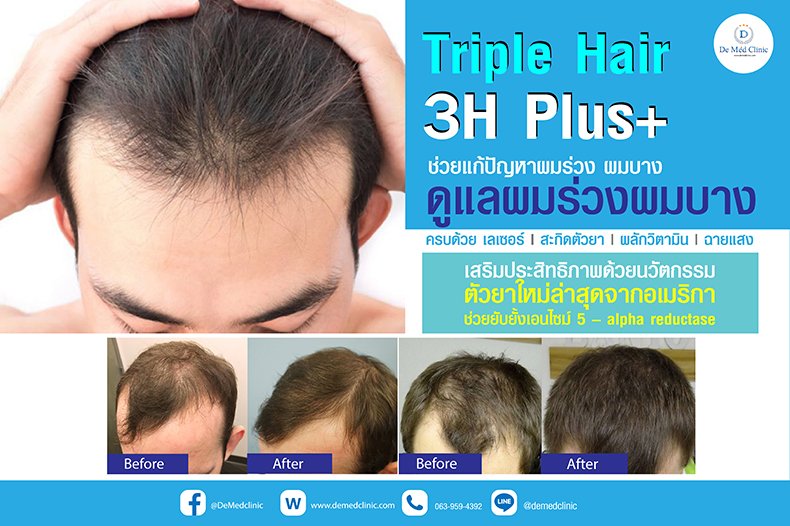 Triple Hair 3H Plus ดูแลผมร่วงผมบาง ครบด้วย เลเซอร์ l สะกิดตัวยา | ผลักวิตามิน | ฉายแสง Triple Hair 3H Plus ดูแลผมร่วงผมบาง ครบด้วย เลเซอร์ l สะกิดตัวยา | ผลักวิตามิน | ฉายแสง