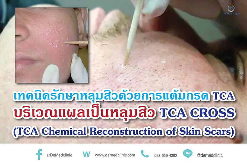เทคนิครักษาหลุมสิวด้วยการแต้มกรด TCA บริเวณแผลเป็นหลุมสิว TCA CROSS (TCA Chemical Reconstruction of Skin Scars) เทคนิครักษาหลุมสิวด้วยการแต้มกรด TCA บริเวณแผลเป็นหลุมสิว TCA CROSS (TCA Chemical Reconstruction of Skin Scars)