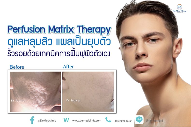 Perfusion Matrix Therapy ดูแลหลุมสิว แผลเป็นยุบตัว ริ้วรอยด้วยเทคนิคการฟื้นฟูจากภายในผิวตัวเอง Perfusion Matrix Therapy ดูแลหลุมสิว แผลเป็นยุบตัว ริ้วรอยด้วยเทคนิคการฟื้นฟูจากภายในผิวตัวเอง