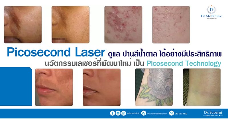Picosecond Laser ดูแล ปานสีน้ำตาล ได้อย่างมีประสิทธิภาพ นวัตกรรมเลเซอร์ที่พัฒนาใหม่ เป็น Picosecond Technology Picosecond Laser ดูแล ปานสีน้ำตาล ได้อย่างมีประสิทธิภาพ นวัตกรรมเลเซอร์ที่พัฒนาใหม่ เป็น Picosecond Technology