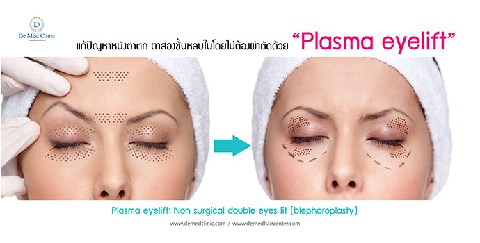 แก้ปัญหาหนังตาตก ตาสองชั้นหลบในโดยไม่ต้องผ่าตัดด้วย “Plasma eyelift” Plasma eyelift: Non surgical double eyes lit (blepharoplasty)