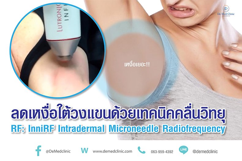 ลดเหงื่อใต้วงแขนด้วยเทคนิคคลื่นวิทยุ RF: InfiniRF Intradermal Microneedle Radiofrequency ลดเหงื่อใต้วงแขนด้วยเทคนิคคลื่นวิทยุ RF: InfiniRF Intradermal Microneedle Radiofrequency
