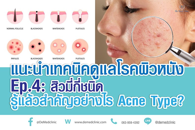 แนะนำเทคนิคดูแลโรคผิวหนัง Ep.4: สิวมี่กี่ชนิด รู้แล้วสำคัญอย่างไร Acne Type? แนะนำเทคนิคดูแลโรคผิวหนัง Ep.4: สิวมี่กี่ชนิด รู้แล้วสำคัญอย่างไร Acne Type?
