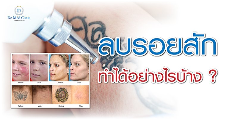 ลบรอยสัก ทำได้อย่างไรบ้าง ? ลบรอยสัก ทำได้อย่างไรบ้าง ?