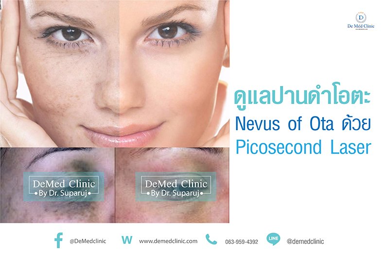 ดูแลปานดำโอตะ Nevus of Ota ด้วย Picosecond Laser ดูแลปานดำโอตะ Nevus of Ota ด้วย Picosecond Laser