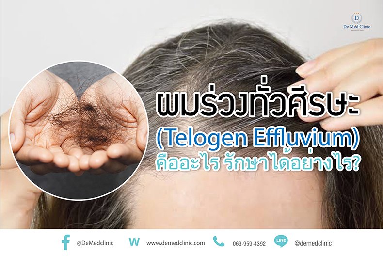 ผมร่วงทั่วศีรษะ (Telogen Effluvium) คืออะไร รักษาได้อย่างไร? ผมร่วงทั่วศีรษะ (Telogen Effluvium) คืออะไร รักษาได้อย่างไร?