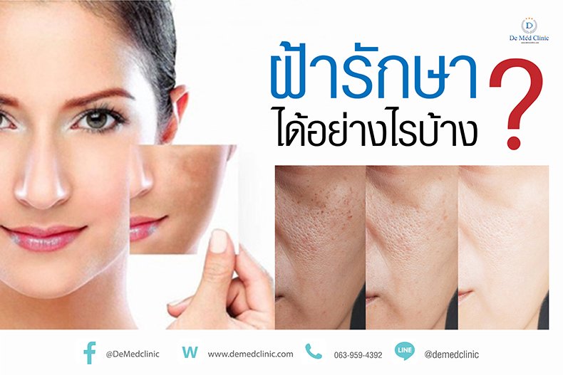 ฝ้ารักษาได้อย่างไรบ้าง ฝ้ารักษาได้อย่างไรบ้าง