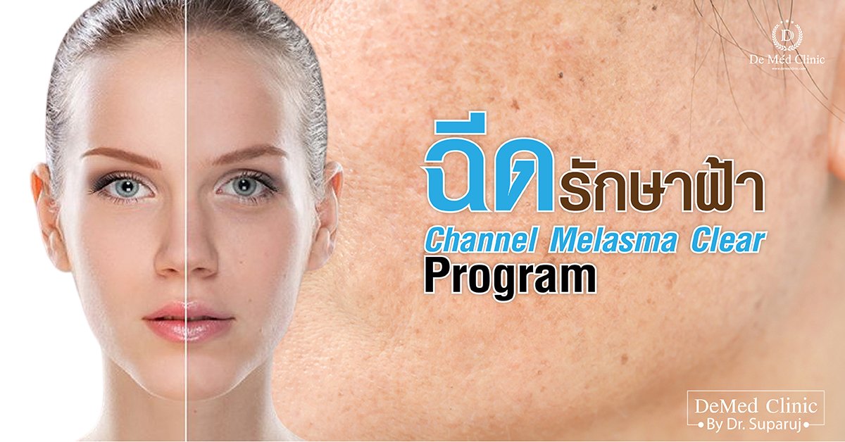 โปรแกรมฉีดรักษาฝ้า Channel Melasma Clear Program ที่ DeMed Clinic โปรแกรมฉีดรักษาฝ้า Channel Melasma Clear Program ที่ DeMed Clinic