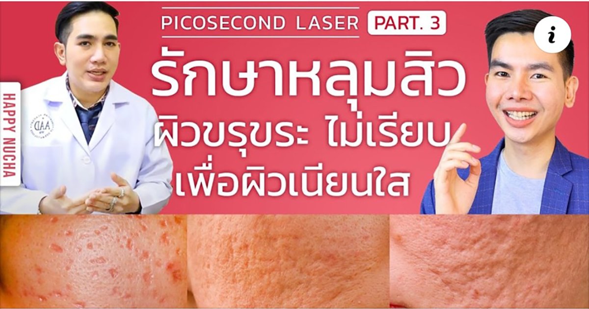 ขอขอบคุณ คุณนุชา Happy Nucha สำหรับการรีวิวการรักษาหลุมสิวกับหมอรุจครับ  ขอขอบคุณ คุณนุชา Happy Nucha สำหรับการรีวิวการรักษาหลุมสิวกับหมอรุจครับ