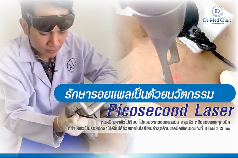 รักษารอยแผลเป็นด้วยนวัตกรรม Picosecond Laser หมดปัญหาผิวไม่เรียบ ไม่สวยจากรอยแผลเป็น หลุมสิว หรือรอยแผลทุกชนิด รักษารอยแผลเป็นด้วยนวัตกรรม Picosecond Laser หมดปัญหาผิวไม่เรียบ ไม่สวยจากรอยแผลเป็น หลุมสิว หรือรอยแผลทุกชนิด